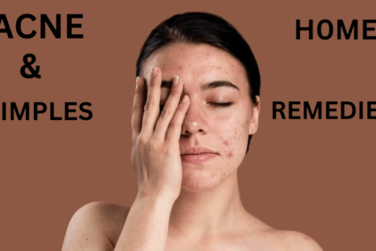 Acne and pimples home remedies