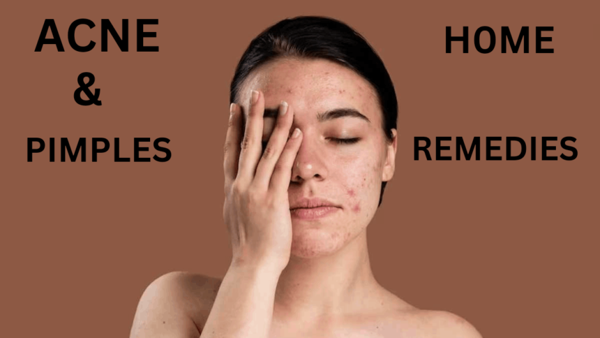 Acne and pimples home remedies