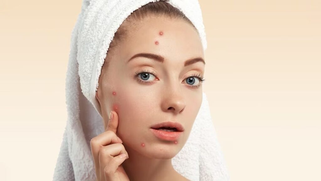 pimple से घुटकारा पाने के लिए 7 घरेलू उपाय यहां दिए गए हैं