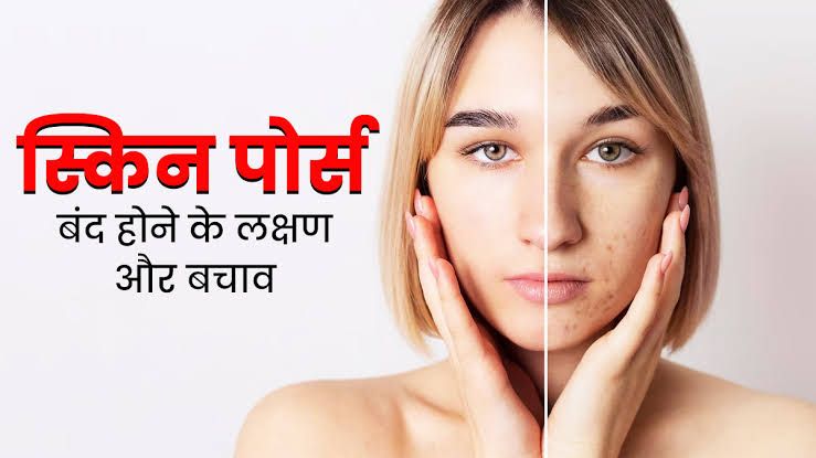 ओपन पोर्स होने के कारण (open pores on face causes)