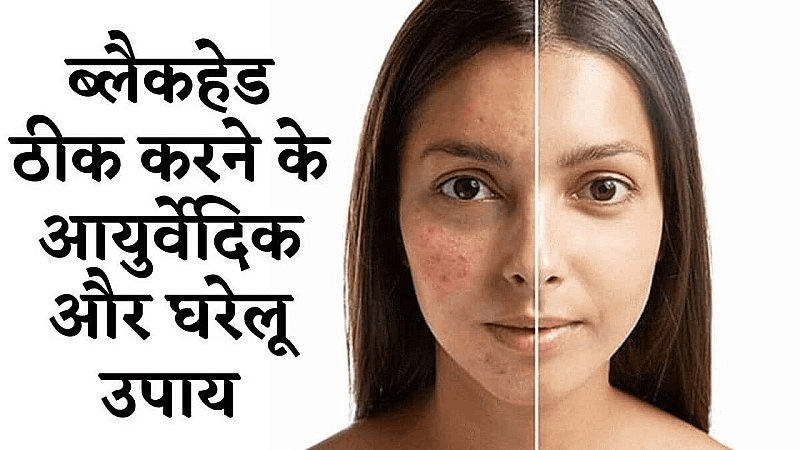 Remove Blackheads in hindi 