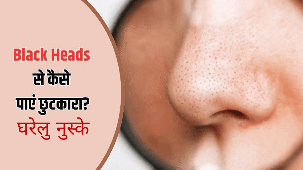 Remove Blackheads in hindi 
