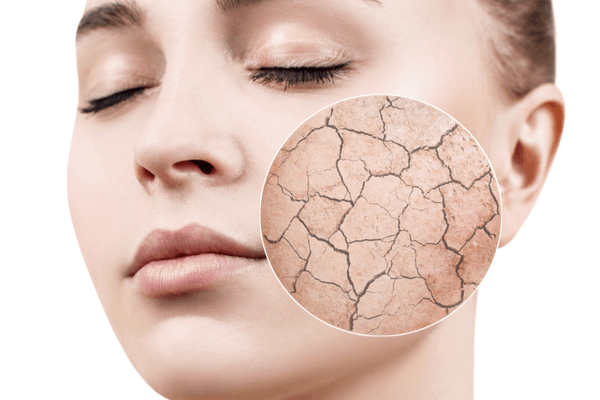 Dry skin in hindi home remedies 